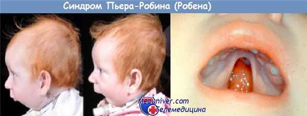Синдром Пьера-Робина (Робена)