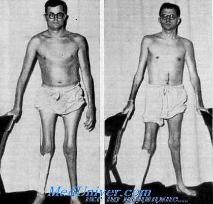 синдром розенберга-хаториана у пациента