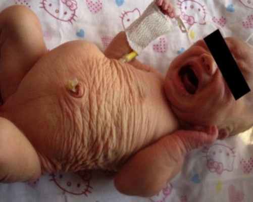 Синдром сливового живота