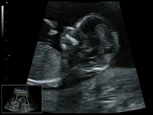 Микрогнатия - сагиттальный скан в 2D, беременность 13 нед