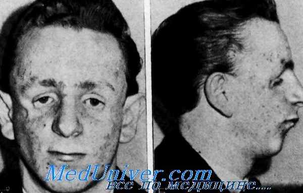 челюстно-лицевой дизостоз