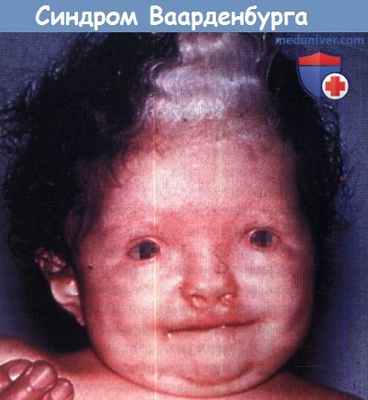 Синдром Ваарденбурга типа 1