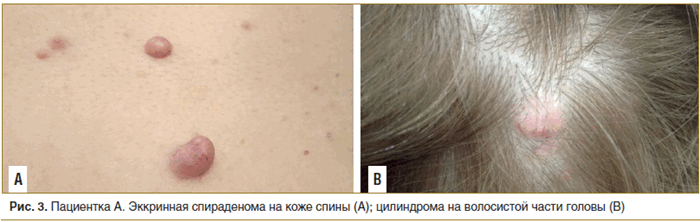 Рис. 3. Пациентка А. Эккринная спираденома на коже спины (А); цилиндрома на волосистой части головы (В)