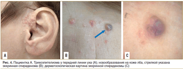 Рис. 4. Пациентка А. Трихоэпителиома у передней линии уха (А); новообразования на коже лба, стрелкой указана эккринная спираденома (В); дерматоскопическая картина эккринной спираденомы (С)