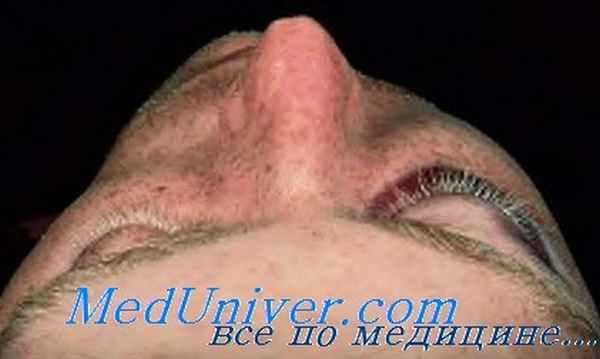 синдром вершины орбиты