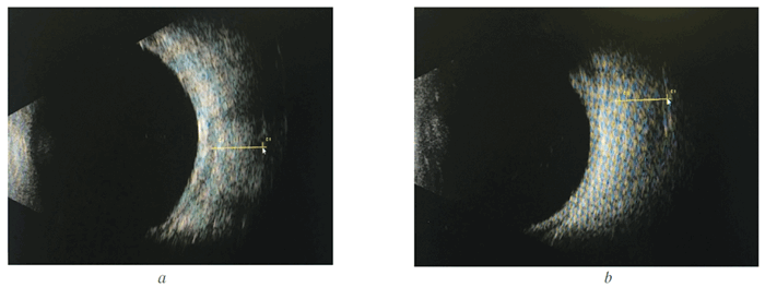 Псевдотумор орбиты