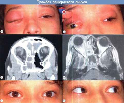 Тромбоз пещеристого синуса