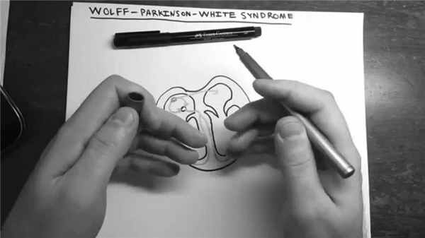 Синдром Вольфа-Паркинсона-Уайта: что это