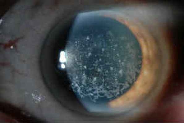 Дистрофия роговицы глаза