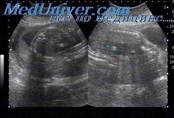 гидролетальный синдром