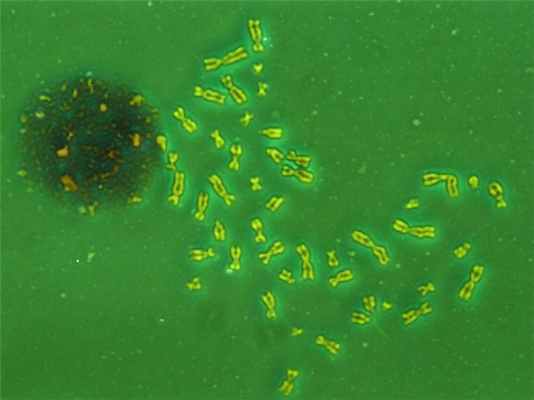 Набор хромосом человека с синдромом Клайнфельтера