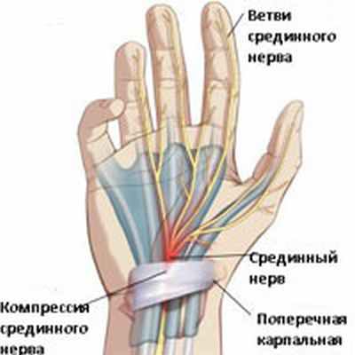 Синдром запястного канала (карпальный туннельный синдром)