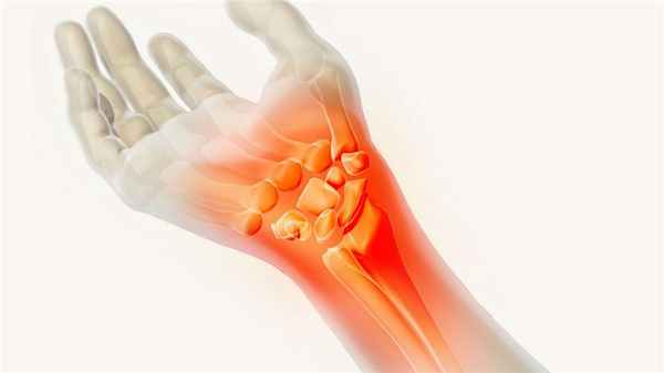 Синдром запястного канала