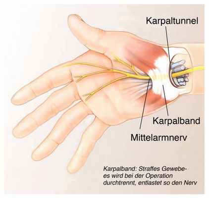 Особенность туннельного синдрома — это сужение срединного нерва запястной связкой, проходящей в кистевом суставе. © Henrie, Adobe Stock
