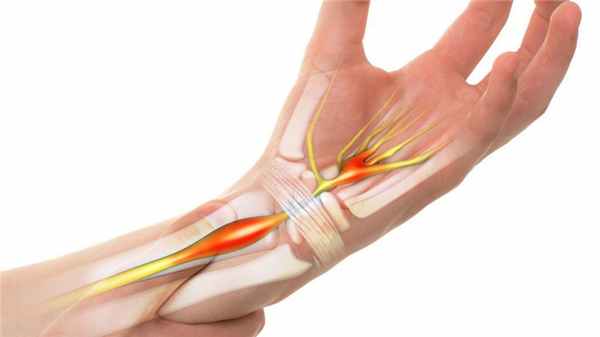 Синдром запястного канала