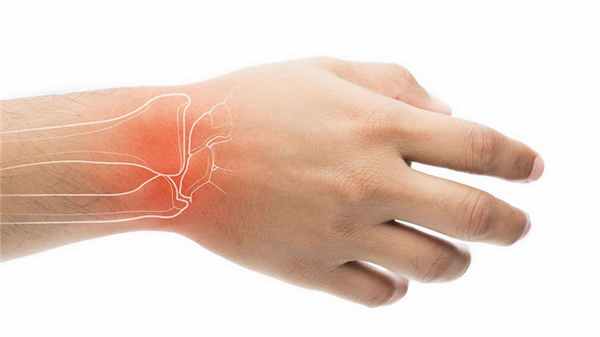 Синдром запястного канала