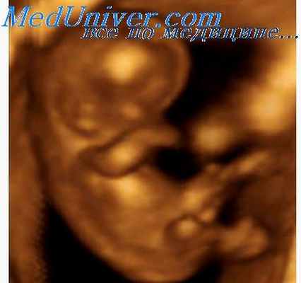 тромбоцитопения