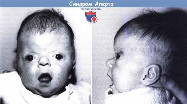 Синдром Аперта