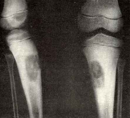 Диагностика фибромы