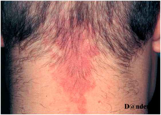 Простая капиллярная гемангиома