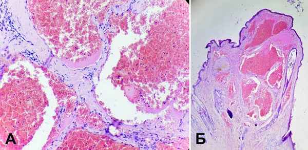 Кожная гемангиома гистология