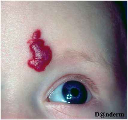 Кавернозная гемангиома 