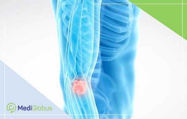 что такое синовиальная саркома