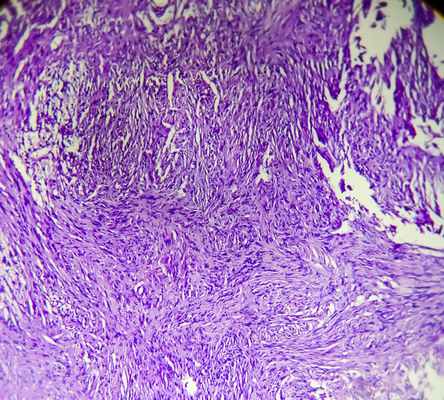 Лечение синовиальной саркомы