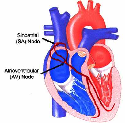 arrhythmia