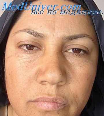 тромбоцитопения при пороке сердца