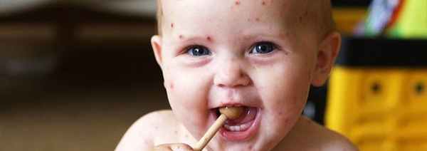 сыпь на теле