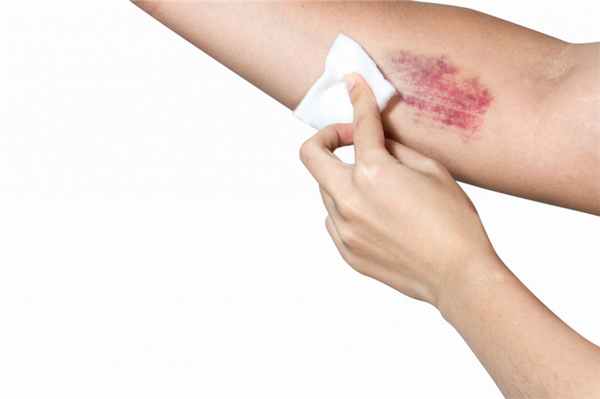 петехиальная сыпь.jpg