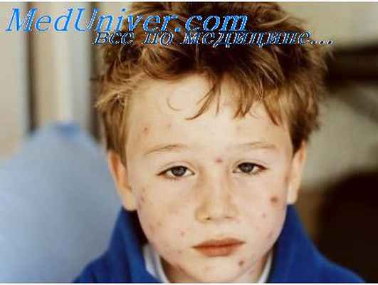 сыпь при ветряной оспе