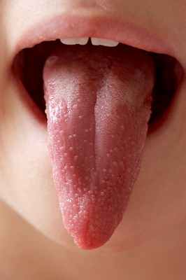 Язык при скарлатине.jpg