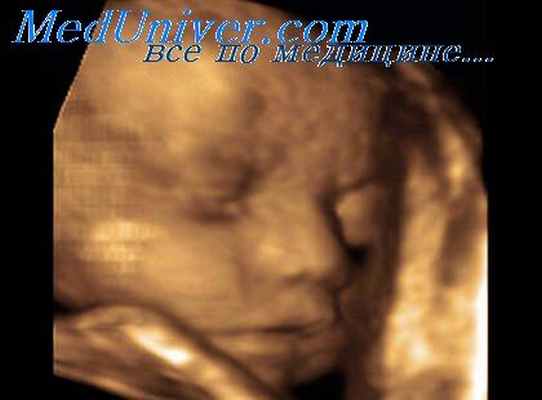 сиреномелия