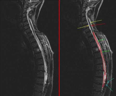 Сирингомиелия