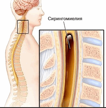 Сирингомиелия