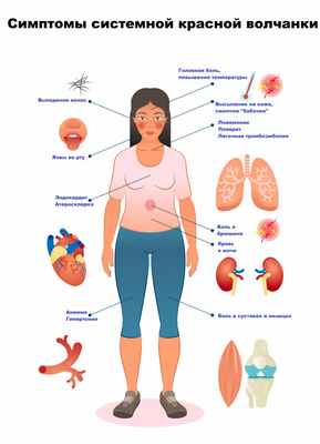 Симптомы волчанки.jpg