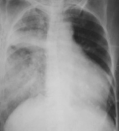 Односторонний отек легких