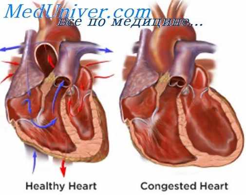 сердечная недостаточность
