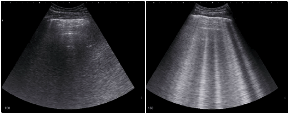 Ультразвуковое исследование при отеке легких