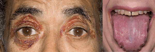 AL амилоидоз