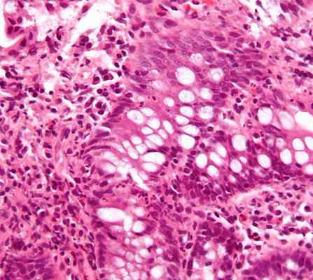 Фото Склерит