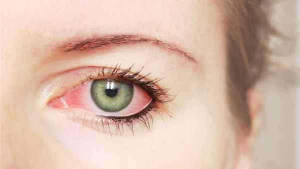 Лечение склерита