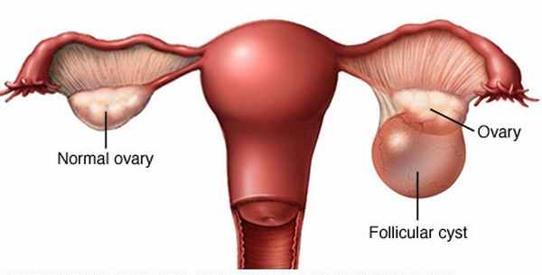 Удаление фолликулярной кисты яичника в Калининграде