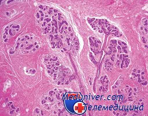 опухоль яичников