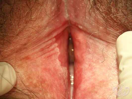 Крауроз вульвы, 1 стадия