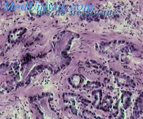 аденома предстательной железы