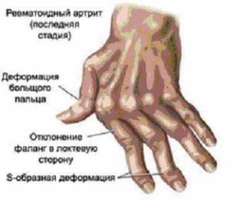 Ревматоидный артрит