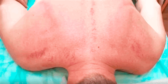 пятна после массажа гуаша